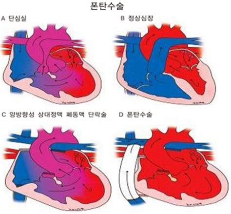 반쪽심장 폰탄수술로 정상생활