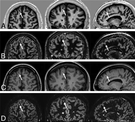 3d Quantitative Synthetic Mri In The Evaluation Of Multiple Sclerosis