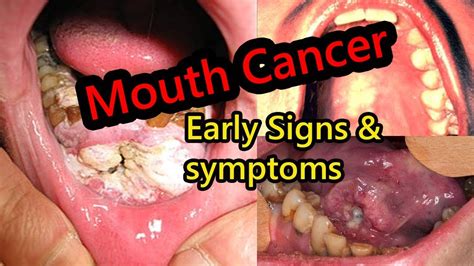 What Does Early Signs Of Mouth Cancer Look Like Oral Cancer