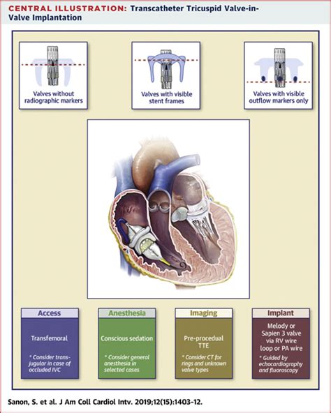 Transcatheter Tricuspid Valve In Valve And Valve In Ring Implantation