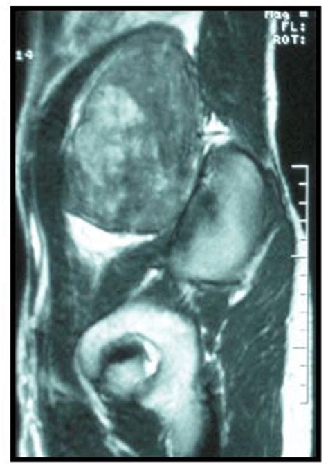 Full Text Huge Retroperitoneal Schwannoma In A Young Male