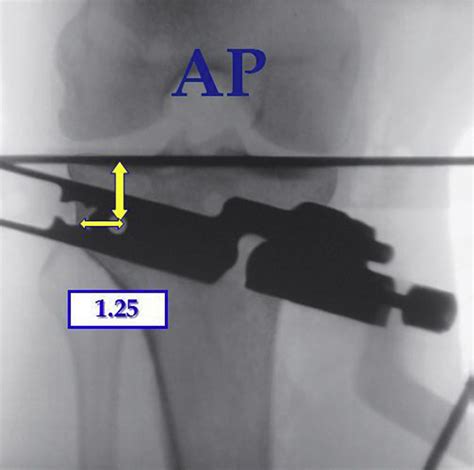 Opening Wedge Proximal Tibial Osteotomy Arthroscopy Techniques