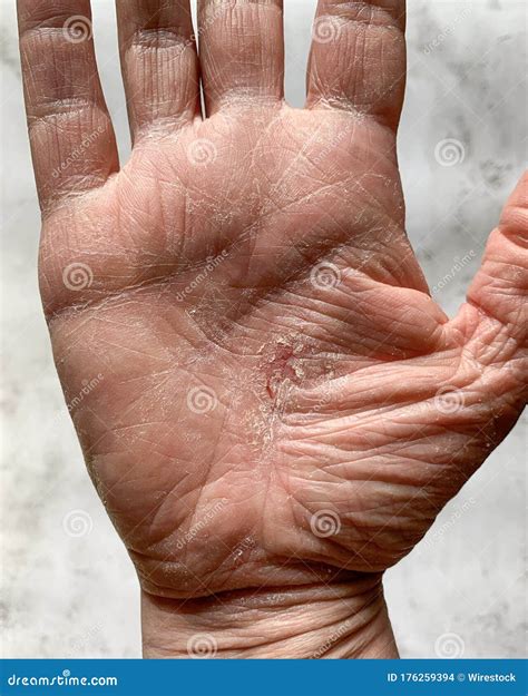 Vertical Shot Of A Hand With A Dry Cracked Skin Stock Photo Image Of