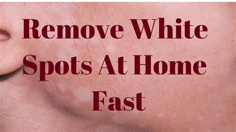 Remove White Spots On Face Only 3 Remedies Spots On Face Skin
