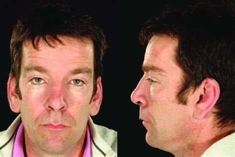 Typical Facial Dysmorphism In A Patient With Fabry Disease Male