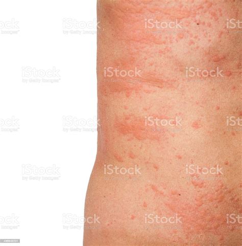 Allergic Skin Reaction Body Isolated Stock Photo Download Image Now