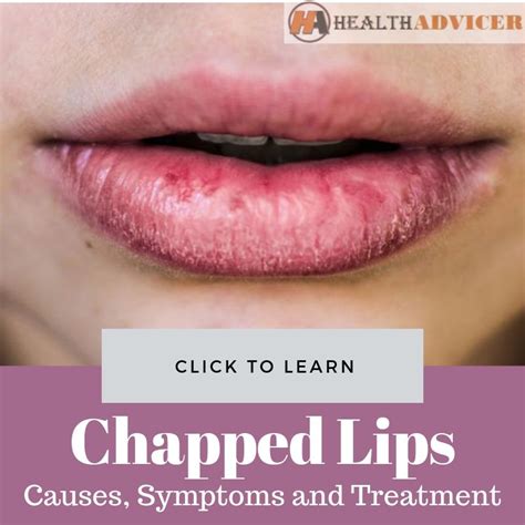 dry lips causes and treatment