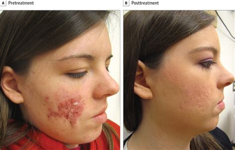 Efficacy Of Fixed Daily 20 Mg Of Isotretinoin In Moderate To Severe Scar Prone Acne