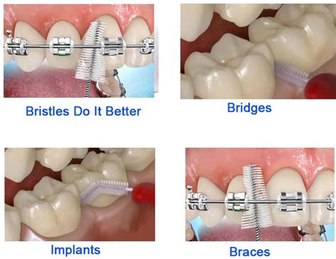 How To Use Interdental Brush Addc Dental Alexander Drive Dental Clinic