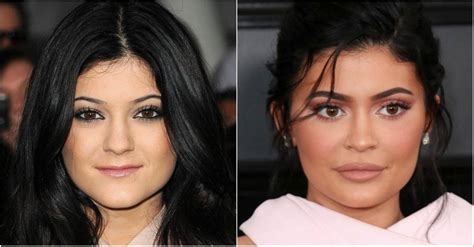 Kylie Jenner Asegura Que Nunca Se Ha Hecho Cirugías Y Sus Fotos Dicen