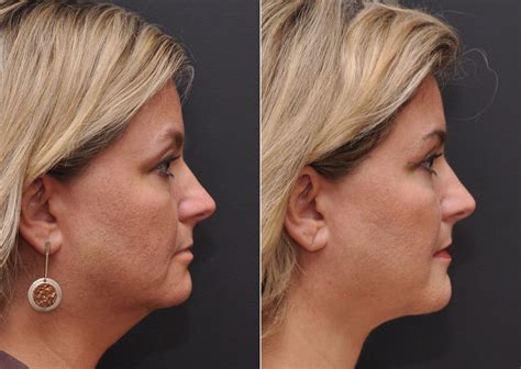 Facial Liposuction Photos Cincinnati Facial Plastic Surgery
