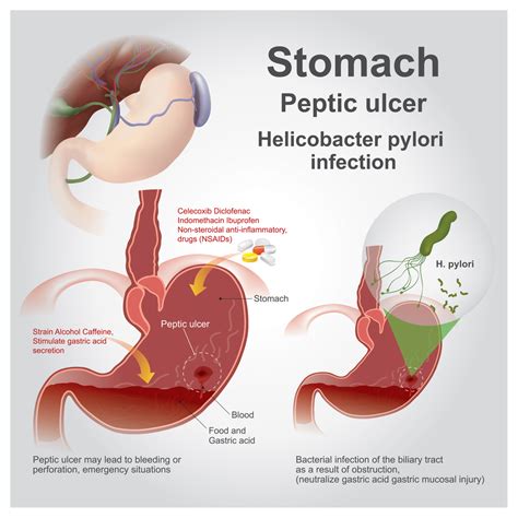 What Are The Signs Of Duodenal Ulcers Ulcertalk Hot Sex Picture