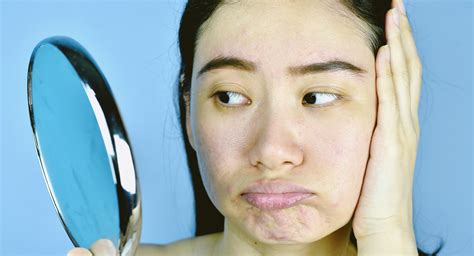 Do You Know What Really Causes Acne Liver Doctor