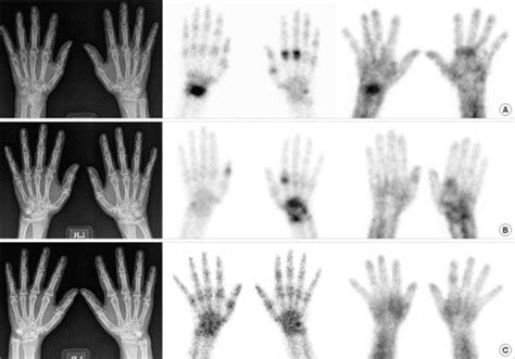 Pdf Bone Scintigraphy In The Diagnosis Of Rheumatoid Arthritis Is