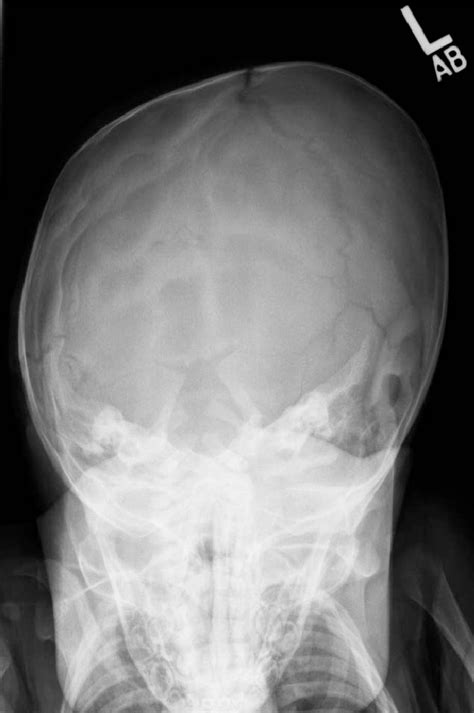 Figure 2 From Diagnostic Yield Of Routine Skull Radiographs In Infants
