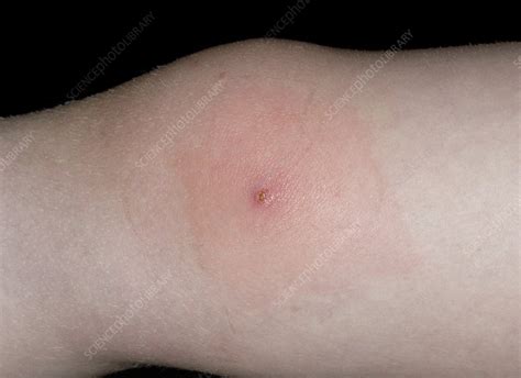 Infected Molluscum Contagiosum On Knee Stock Image C0051834