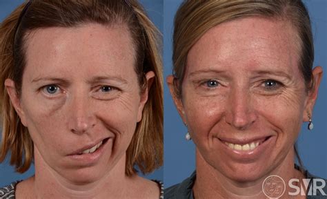 Nerve Transfer For Smile Restoration Before And After Pictures Case 1