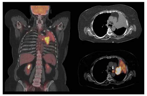 Frontiers Current Concepts In F18 Fdg Petct Based Radiation Therapy
