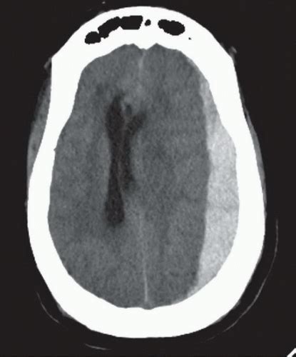 Acute Subdural Hematoma Radiology Key