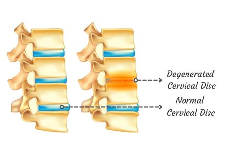 cervical degenerative disc disease how to manage it