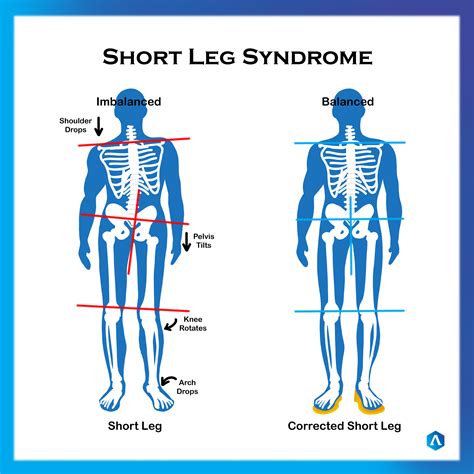 Short Leg Dr Abbie Clinics