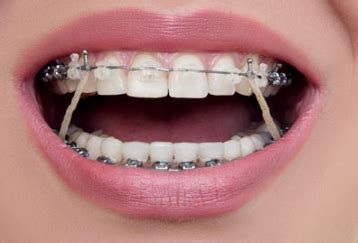 Ini bertujuan menyusun semula gigitan demi mereka yang memerlukan pendakap gigi adalah individu yang mempunyai tiga masalah iaitu jongang gigi barisan atas atau bawah, masalah susunan. Borang Permohonan Braces Kerajaan 2020