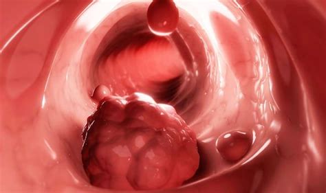 A cancerous breast lump will usually be hard and immobile when you push on it. Bowel cancer symptoms: Signs of tumour include blood in ...