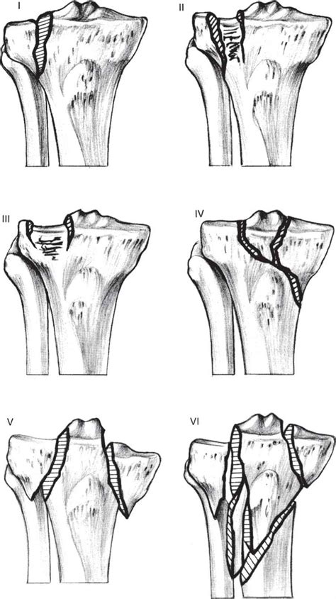 Fractures Of The Tibia Musculoskeletal Key