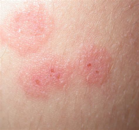 Pityriasis Rosea Causes Pictures Photos