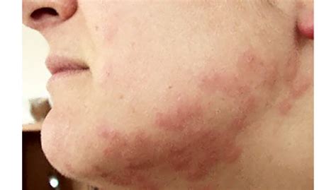 Allergic Reaction Bed Bug Rash Images 10lilian