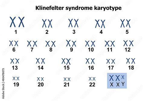 Klinefelter Syndrome Karyotype Stock Vektorgrafik Adobe Stock
