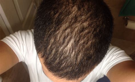 If you have noticeably thin hair and are trying to figure out how to style it, a buzz cut will work with the hair you do have. September selfies: post hairline photos here for opinions ...