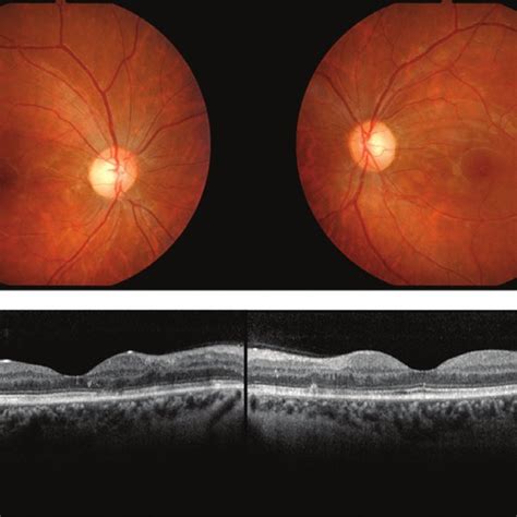 Initial Fundus Photography Fluorescein Angiography And Optical