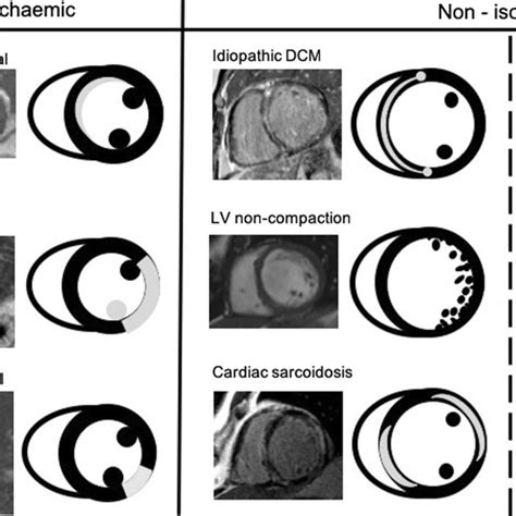 Patterns Of Late Gadolinium Enhancement And Corresponding Cardiac Mri