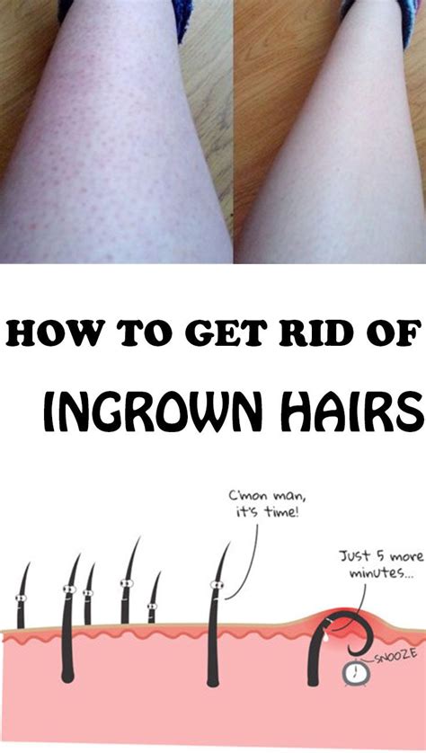 Ingrown hairs can happen wherever there is hair on the body, but dr. Pin on Do It Yourself Today