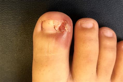 Prevention And Treatment For Recurring Ingrown Toenails Pod Fit Adelaide