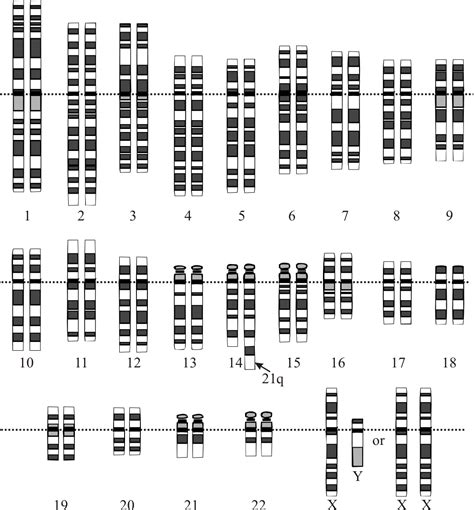 Karyotype down syndrome chromosomal abnormalities chromosomes microscope white blood cells. Genetic origins of Down syndrome - wikidoc