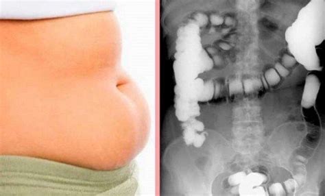 Remove The Swelling In Your Belly In 10 Minutes Bloated Stomach