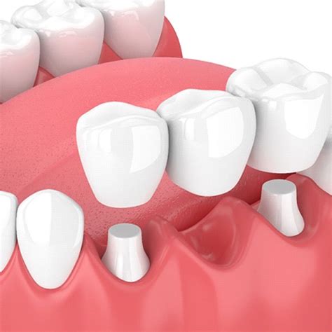 Dental Bridges Missing Teeth Dental Center Of Huntington