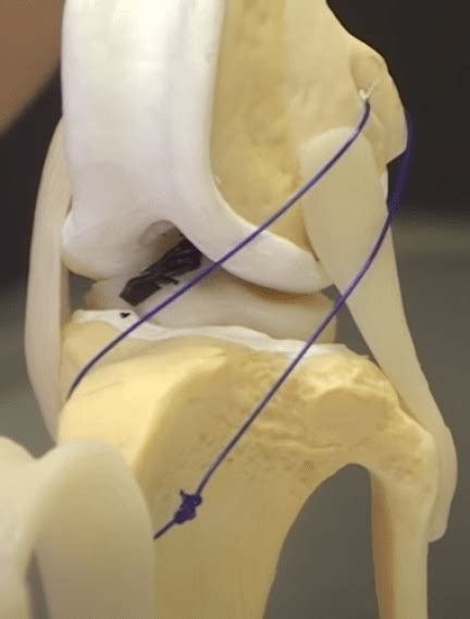 Ccl Injuries Extracapsular Repair Lateral Suture Stabilization Lss