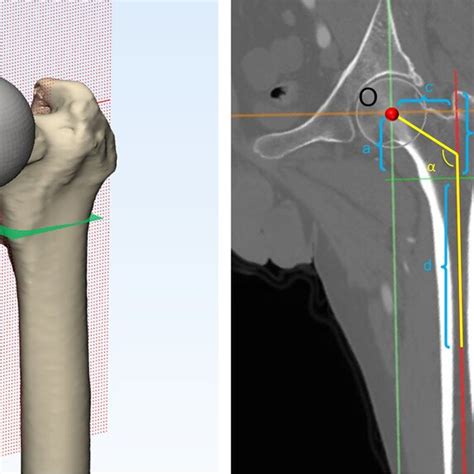 3d Model And The Coronal Femoral Plane Of The Proximal Femur Of Ddh O
