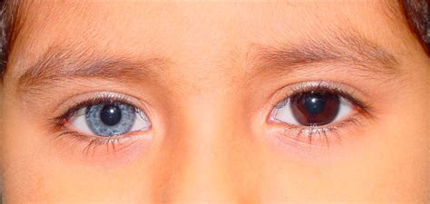 Heterochromia What Is It Causes Types Risk Factors And Treatment