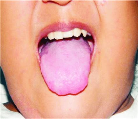 Complete Healing Of Ulcers On Dorsum Of The Tongue Download