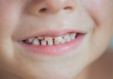 When Do Baby Teeth Fall Out With Caring Tips