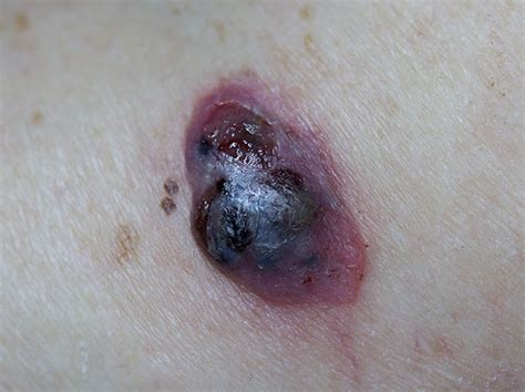 Dog Skin Lesions Or Lumps Due To Cancer With Pictures