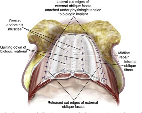 Figure 2 From Open Ventral Hernia Repair With Component Separation