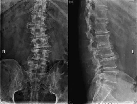 Plain Radiographs Of The Lumbar Spine Shows Degenerative Lumbar