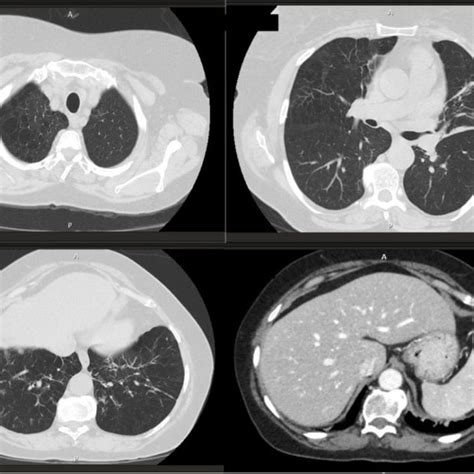 Thoracic Ct Scan Showing Emphysema In Upper Lobes And Bronchiectasis In