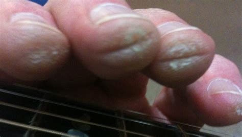 The Amount Of Strain On Your Fingers From Playing Guitar Can Cause Unsightly Calluses The Time