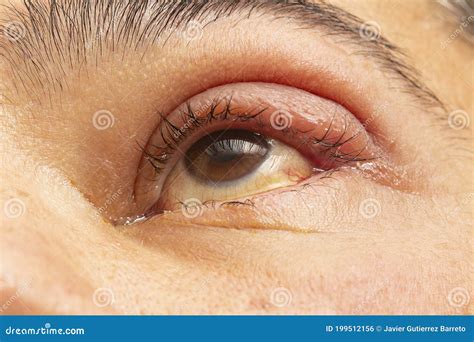 Closeup Of Man Eye With Stye Purging Pus With Doctor Finger With Blue